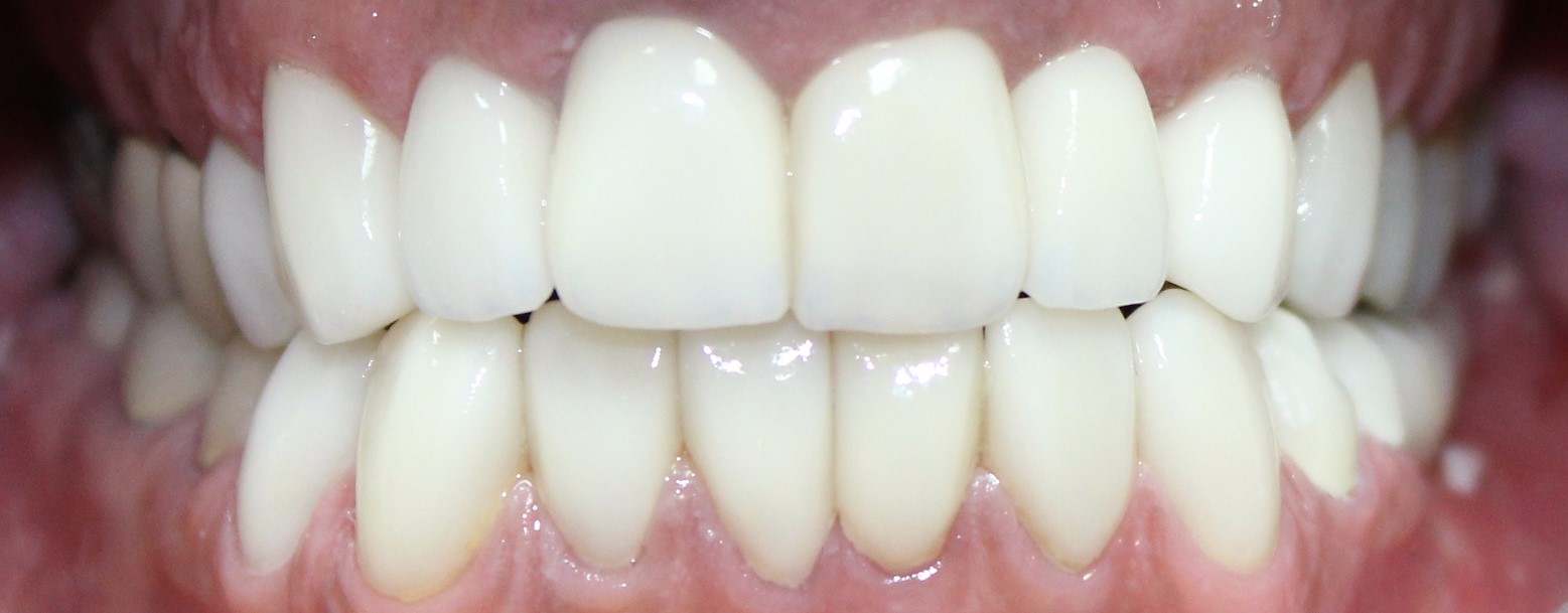 Understanding the 4 Types of Dental Bridges Botsford Dental