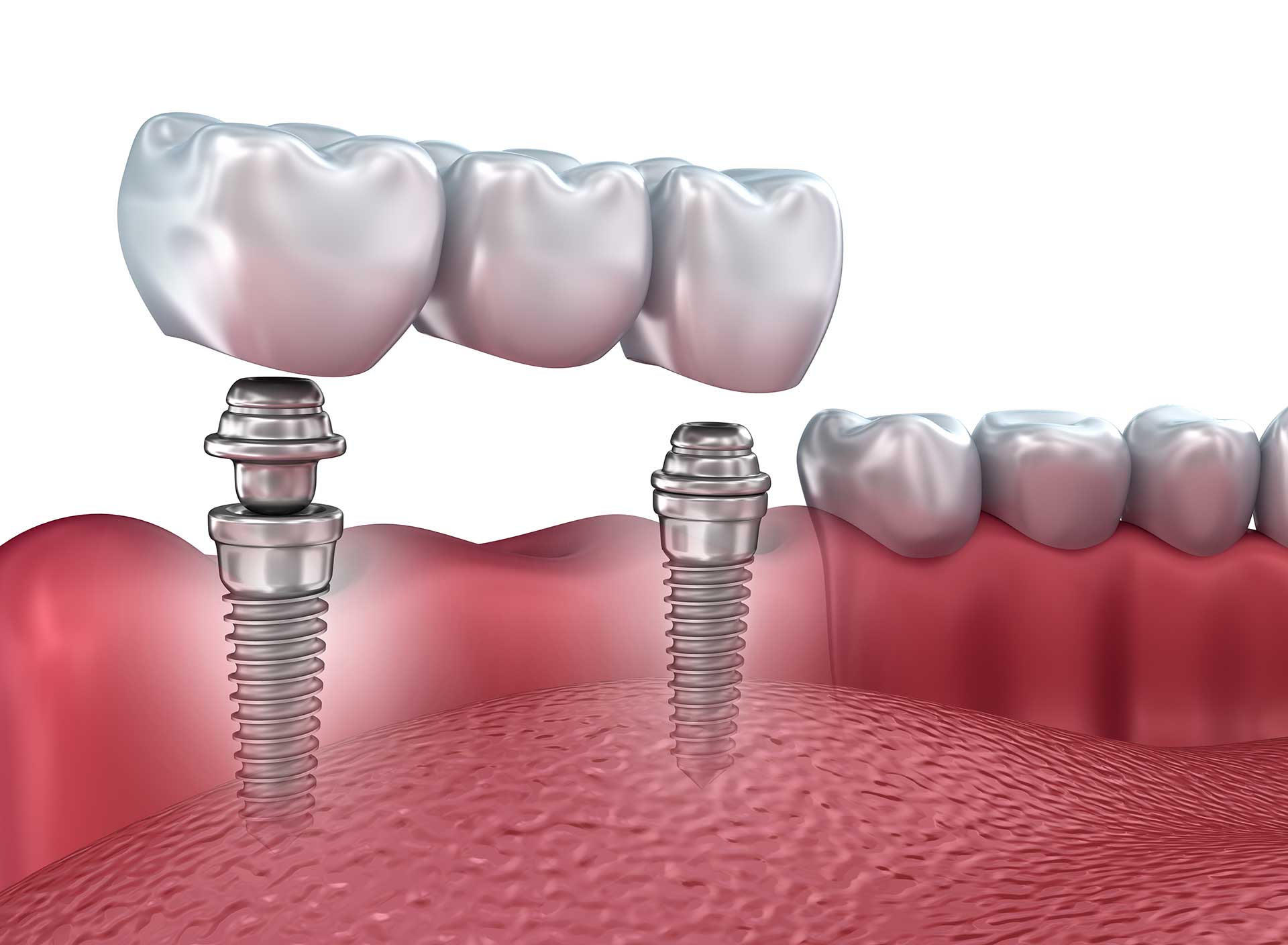 7 Benefits of Dental Implants Botsford Dental