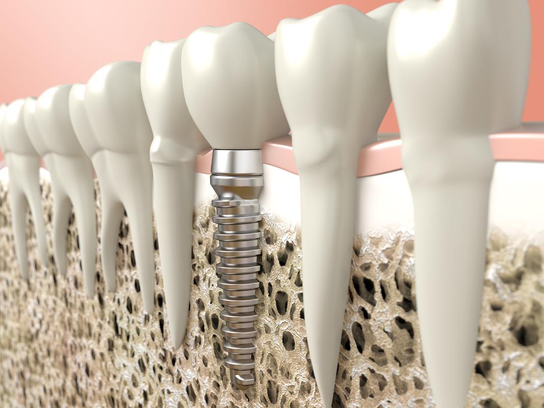 Dental Implants  Medford, OR 